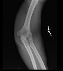g headless screws, TEA Consider patient, x-ray