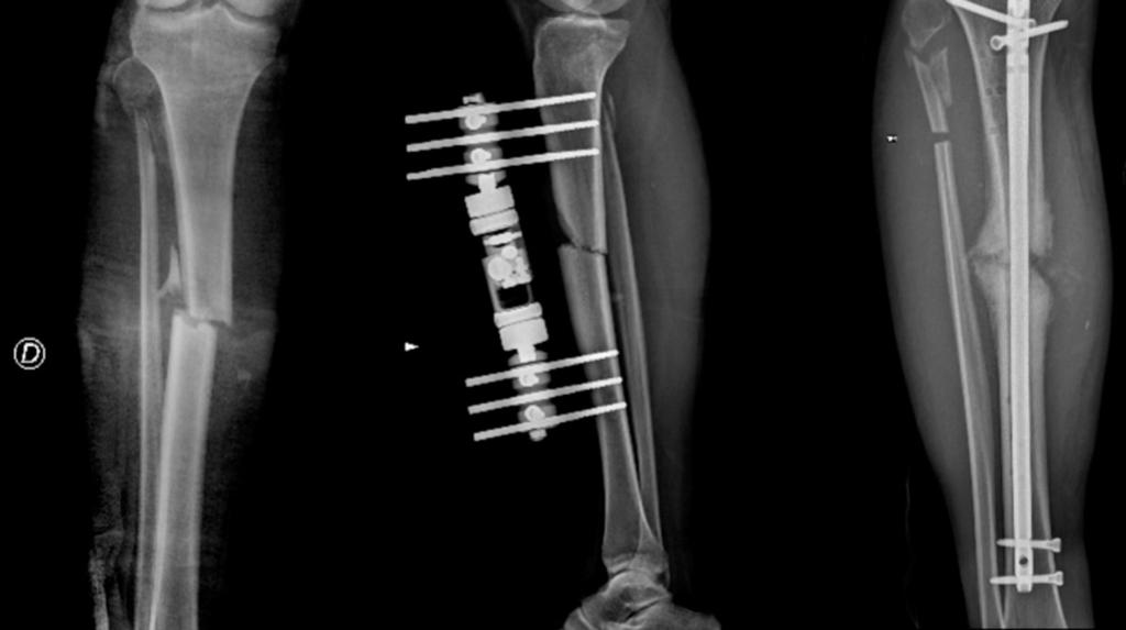 Fig. 10: Radiographs of a hypertrophic tibial non union.
