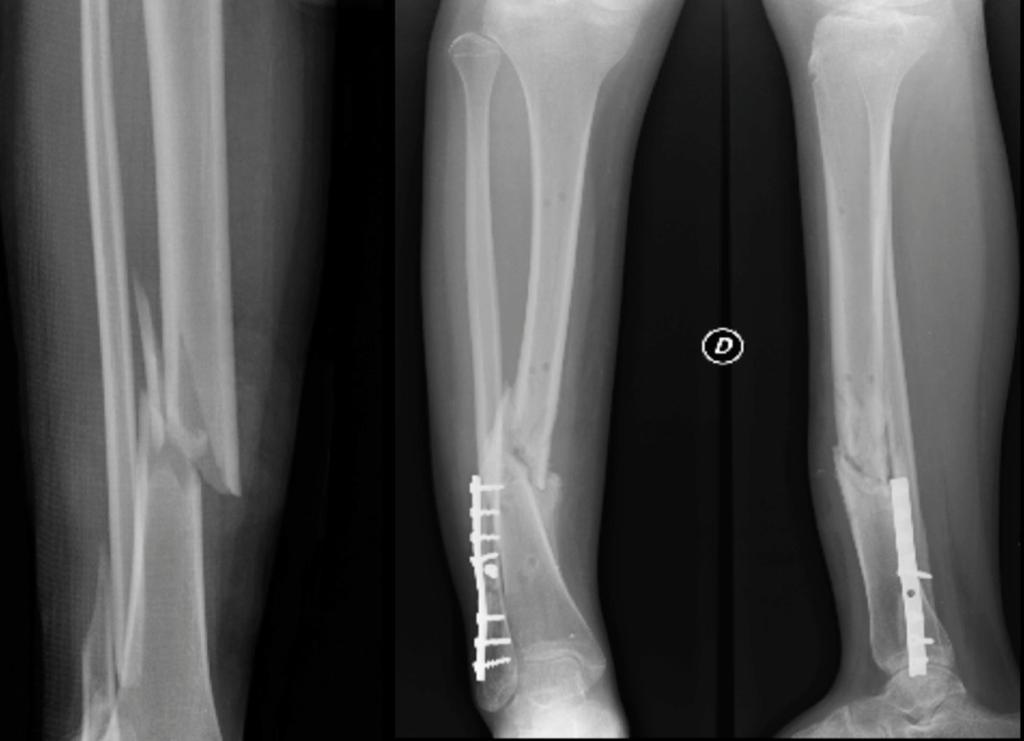 Fig. 11: Radiographs of a hypertrophic tibial and fibular non union.