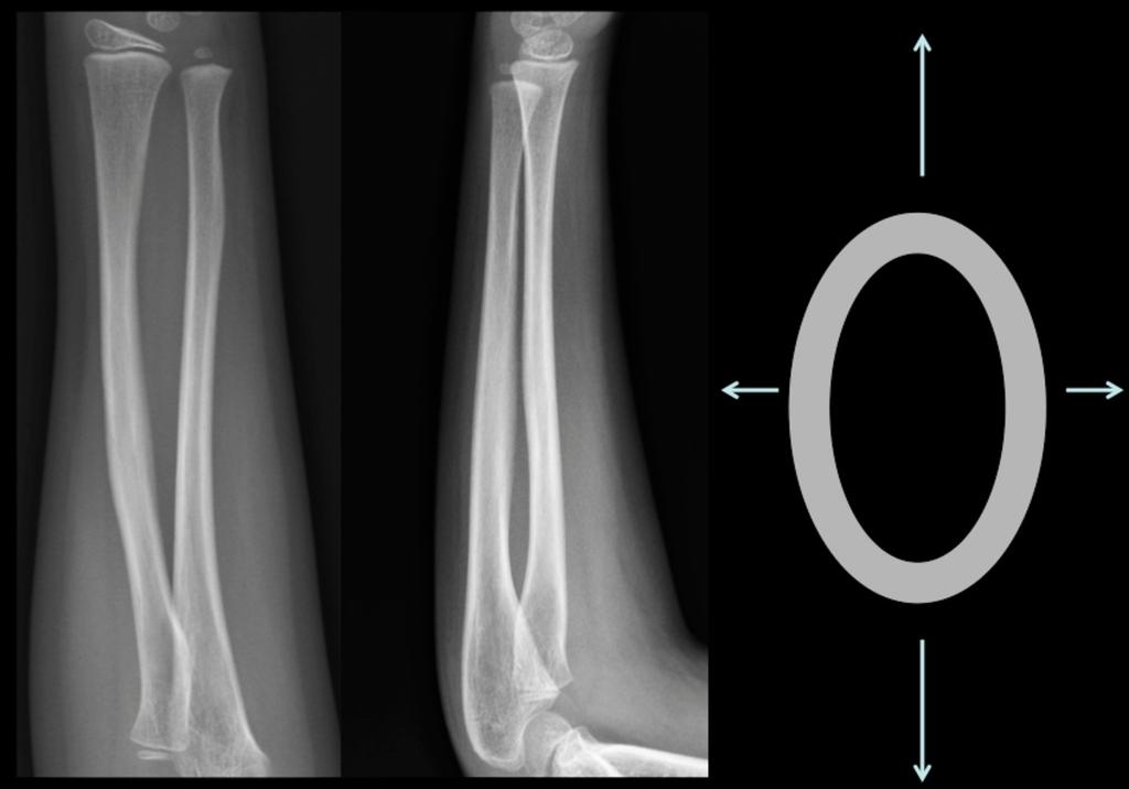 Fig. 2: 7 years old plain film of forearm.