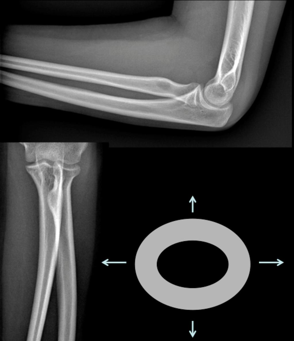 Fig. 3: 14 years old plain film of forearm.