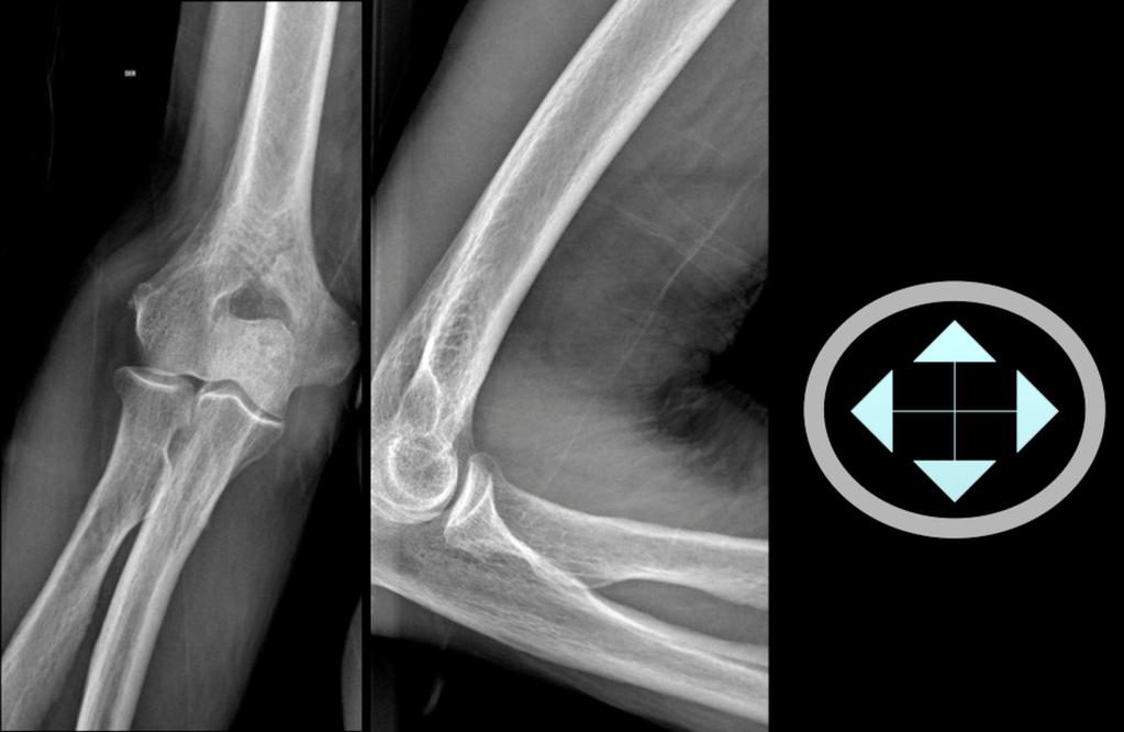 Fig. 4: 81 years old plain film of elbow.