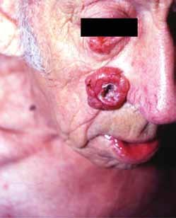 Squamous cell carcinoma Squamous cell carcinoma is the second most common skin cancer, appearing commonly on chronically sun exposed areas such as the face, ears and hands.
