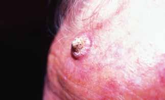 FOCUS Nonmelanoma skin cancers treatment options Figure 5. Rapidly growing keratoacanthoma with a central keratin core women. As with superficial BCC, it may be mistaken for psoriasis or eczema.