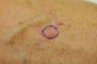 FOCUS Nonmelanoma skin cancers treatment options Prevention of skin cancer All parents of young children should be made aware of the need for sun protection early in life to significantly reduce the