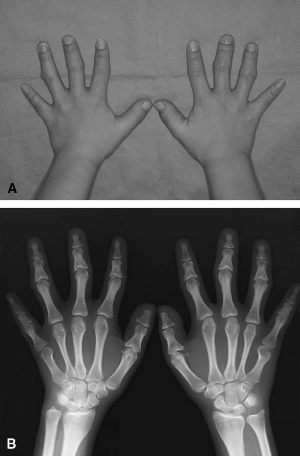 E24 Kunimori et al. February 2006 Fig. 2. Photographs (A) and x-ray photographs (B) of the patient s hands. Brachydactyly and cone-shaped epiphyses of her fingers can be seen. Fig. 1.