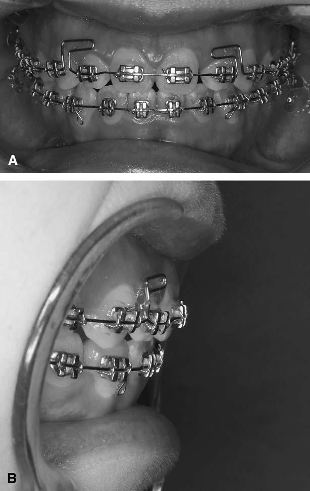 E26 Kunimori et al. February 2006 Fig. 6. Intraoral photographs of the patient 2 years after surgery: frontal (A) and lateral (B) views of the anterior teeth. Fig. 5.
