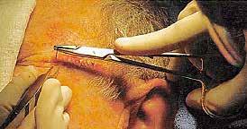 REPAIRING THE SURGICAL WOUND Using Stitches Side-to-side closures These stitches are common for smaller wounds. This involves some adjustment of the wound and stitching the edges together.