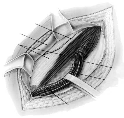 the cut end of the nerve. When the suture is pulled, the cut end of the nerve is directed upward and buried within the muscle fibers. The same suture is used to close the split in the muscle.