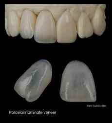 Veneers Dental veneers (dental laminates) are covered the front