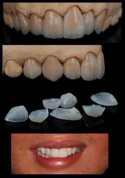 Indications of veneers Esthetically compromised anterior teeth Poorly shaped or crooked teeth Stained teeth
