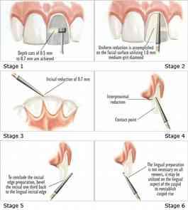 Contraindications of veneers Crowded teeth Teeth with inadequate enamel present Patient with