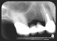 Intraradicular restoration: post and core: Insufficient sound coronal tooth structure due to: Caries Endodontic treatment Previous restorations