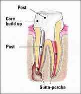 Post diameter Post diameter is to not exceed one-third the root diameter A minimum of 1 mm of sound dentin should be maintained