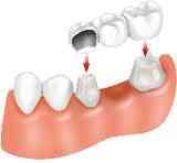 Bridge It is a fixed restoration replaces one or more missing teeth.