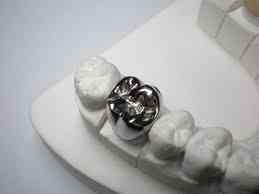 Metal crown: Mainly for posterior teeth (upper arch)