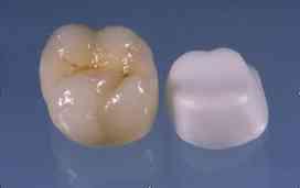 All ceramic Advantage: Superior esthetics Good tissue response marginal gingiva Metal free -