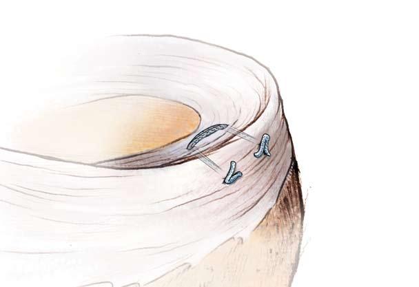 The MaxFire Meniscal Repair System is an all-inside, all-suture meniscal repair