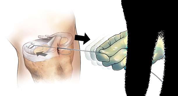 Cannula system safely and precisely controls the placement of