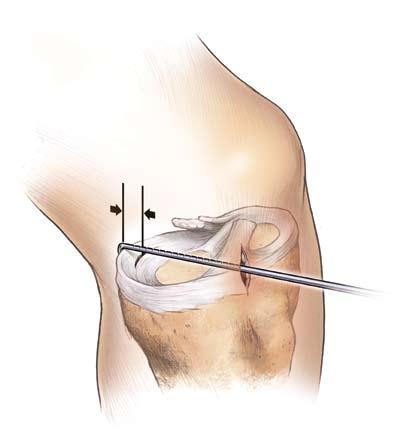 Surgical Technique Figure 1 Figure 2 Diagnostic Arthroscopy Assess the location of the meniscal tear and determine the repairability of the lesion.