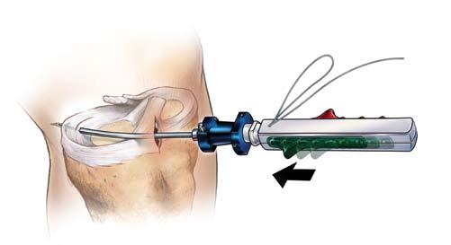 Surgical Technique Figure 6 Figure 7 Load the MaxFire Meniscal Repair Device Insert the MaxFire Meniscal Repair device into the cannula/barrel assembly by aligning the flats of the barrel with either