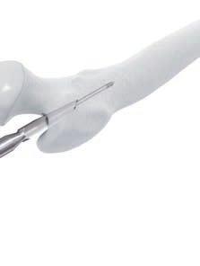 Open Proximal Femur Alternative Technique: Open canal with 14 mm Awl Instruments 357.399 3.2 mm Guide Wire 400 mm 03.010.