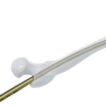 If a reaming rod has been used, do not remove it before the nail has crossed the fracture site.