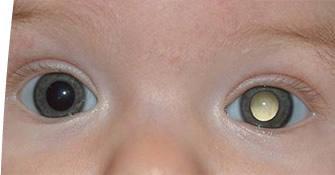 Retinoblastoma Eye cancer develops in childhood Hereditary can be passed on Sporadic one eye