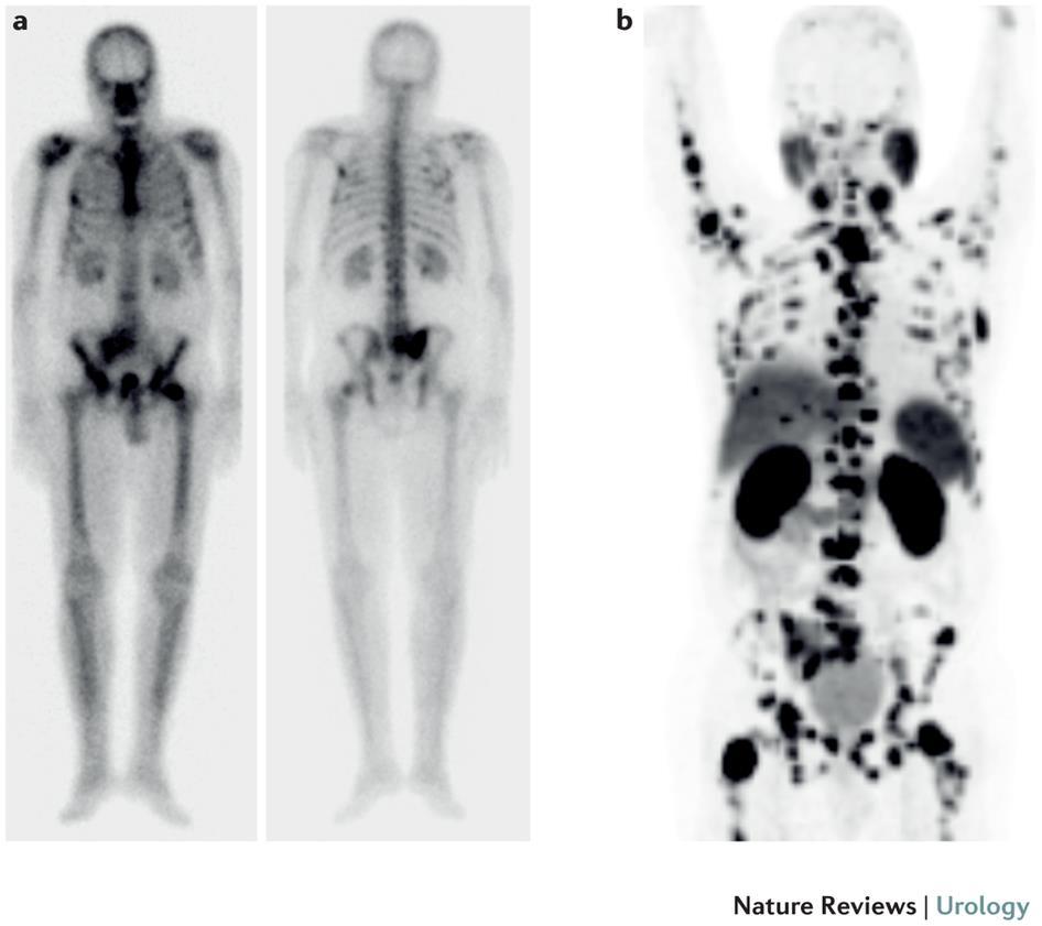 68 Ga-PSMA-PET vs 99 Tc Bone Scan Prostate Cancer