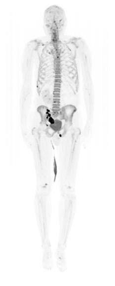PET/CT greater accuracy (with?