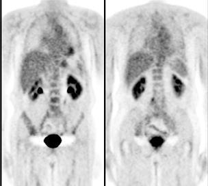 Prostate cancer PET imaging issues