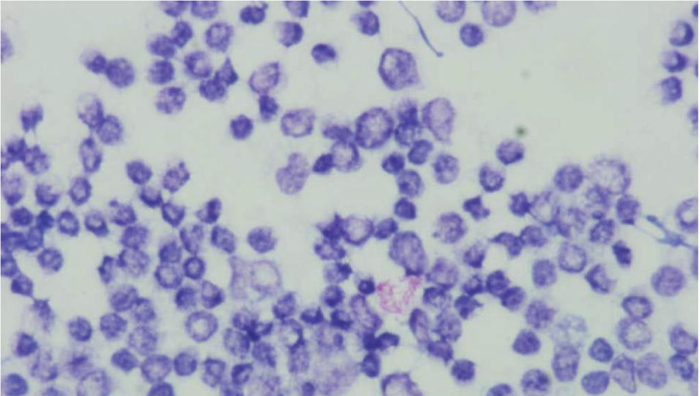 A tuberculin skin test performed after surgery was positive (0 0/30 28). Smear staining from the bronchial aspiration fluid resulted in a Gaffky scale rating of 0.