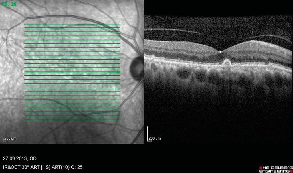 2 RETINA, THE JOURNAL OF RETINAL AND VITREOUS DISEASES 2015 VOLUME 0 NUMBER 0 Fig. 1. Optical coherence tomography scan illustrating VMA.