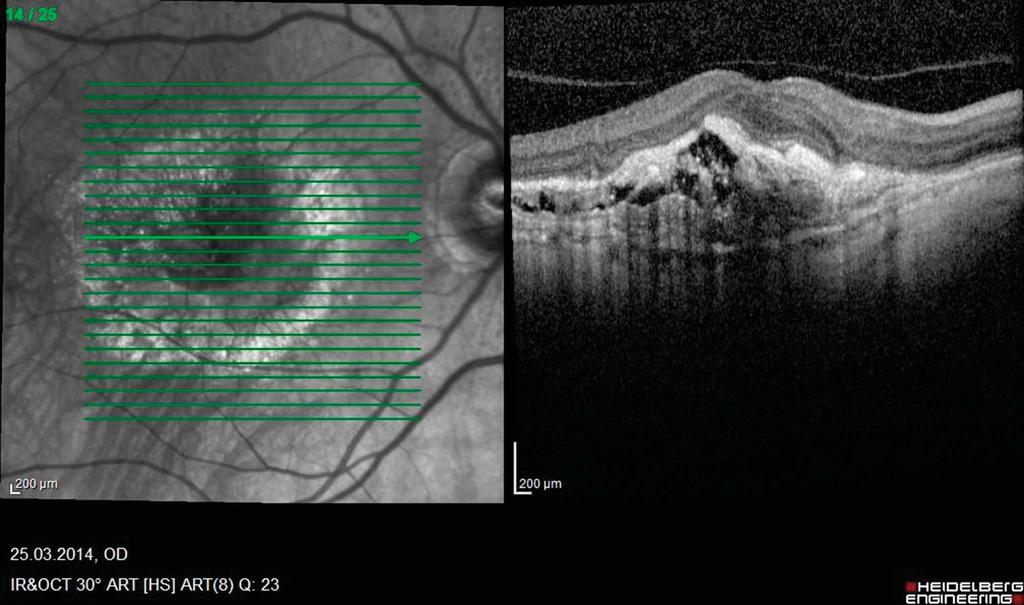 3 6 Several hypotheses have been forwarded accusing attached posterior vitreous as a stimulator of pathology localized in the retinal pigment epithelium.