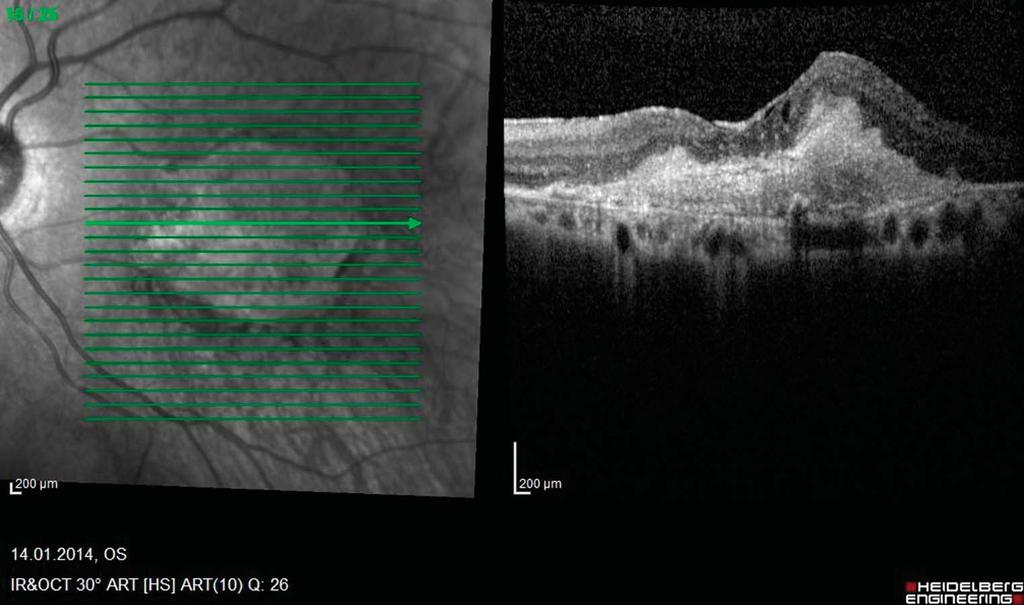 EPIRETINAL MEMBRANE AND AMD KARACA ET AL 3 Fig. 3. Optical coherence tomography scan illustrating ERM with no sign of PVD.