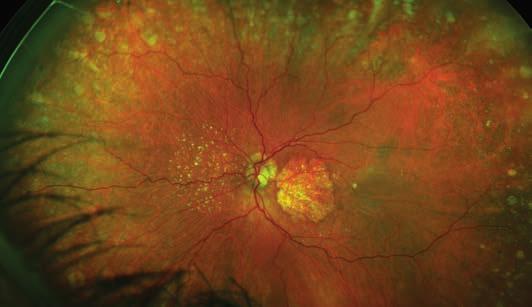 Dry AMD is usually evident as a disturbance of macular pigmentation and deposits of yellowish material under the pigment epithelial layer in the central retinal zone.