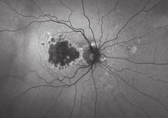 Area of hyperautofluorescence around GA Geographic Atrophy (GA) is associated with dry AMD and is any sharply delineated round