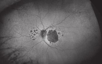Choroidal vessels are more visible than in surrounding areas and must be at least 175 μm in diameter.