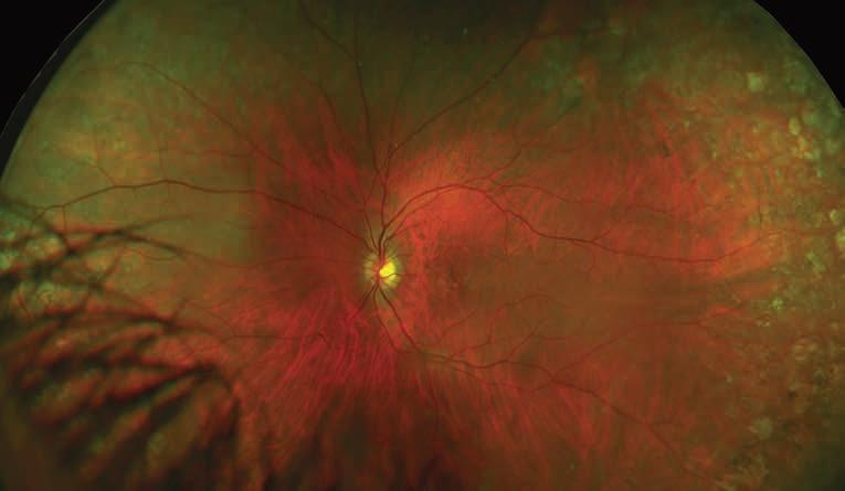 Age-Related Macular Degeneration (AMD, ARMD) Age-Related Macular Degeneration Drusen are tiny hyaline deposits on Bruch s membrane (of the retinal pigment epithelium).