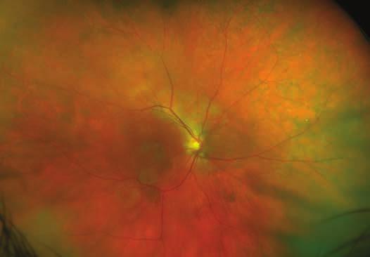 Age-Related Macular Degeneration (AMD, ARMD) Age-Related Macular Degeneration 12 optomap color demonstrates some central atrophy of this atypical