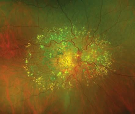 Age-Related Macula Degeneration Patterns of Peripheral AF in AMD In AMD, patterns of AF abnormalities have been shown to be of prognostic
