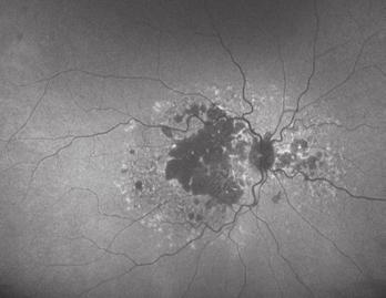 AMD with Geographic Atrophy Granular hyperautofluorescence corresponding to drusen Granular Pattern of retinal degeneration looks like spots of