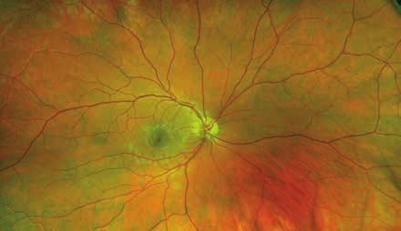 Optic Nerve Head Drusen (ONH Drusen) are hyaline masses or nodules within the optic nerve head.