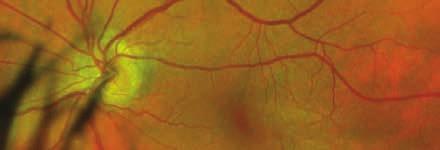 optomap af helps to differentiate ONH drusen from AION (Anterior Ischemic Optic Neuropathy) and field defects.