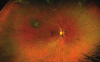 Choroidal nevus disappears in AF