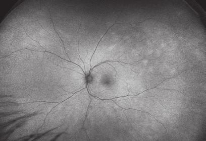 Characterized by small, yellowish choroidal spots and vitreous
