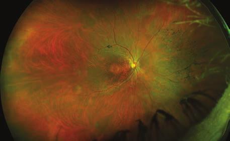 Inherited Disease Retinitis Pigmentosa (RP) is a hereditary, progressive retinal