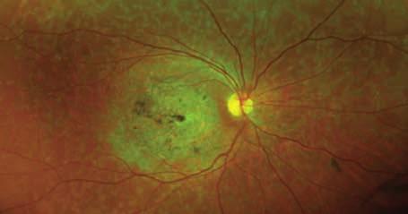 In advanced disease, the macula may show