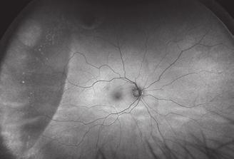 Retinal Detachnment Retinal Detachment (RD) is the separation of the retina from the underlying pigment epithelium.