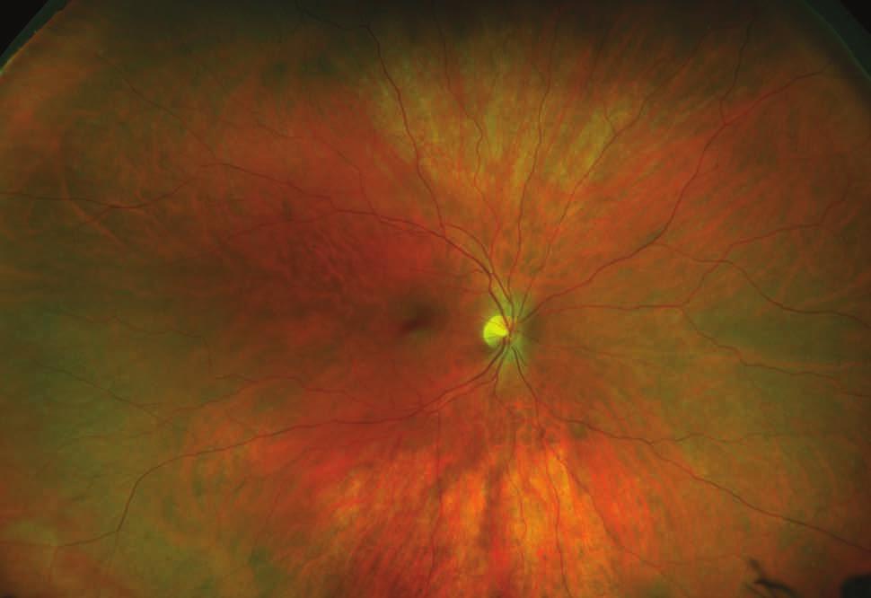 Retinal Anatomy af Diagnostic Atlas Vein is any of the tubes forming part of the blood circulation system of the body, carrying in most cases oxygen-depleted blood toward the heart.